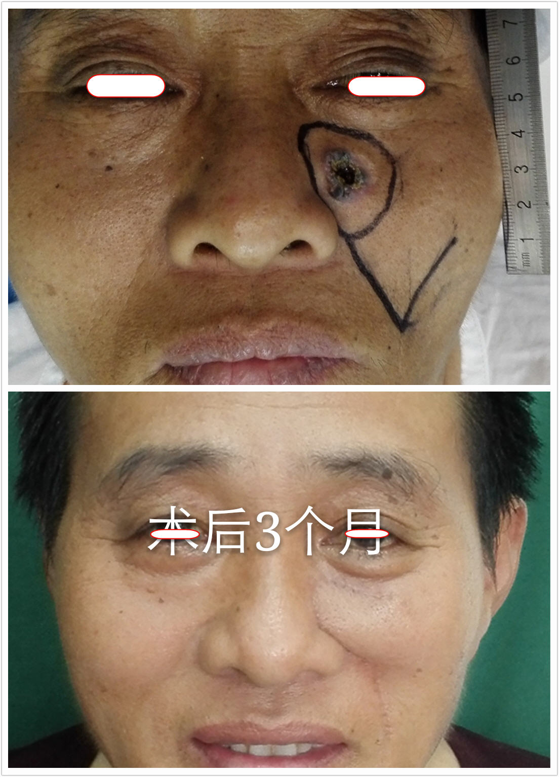 面颊基底细胞癌