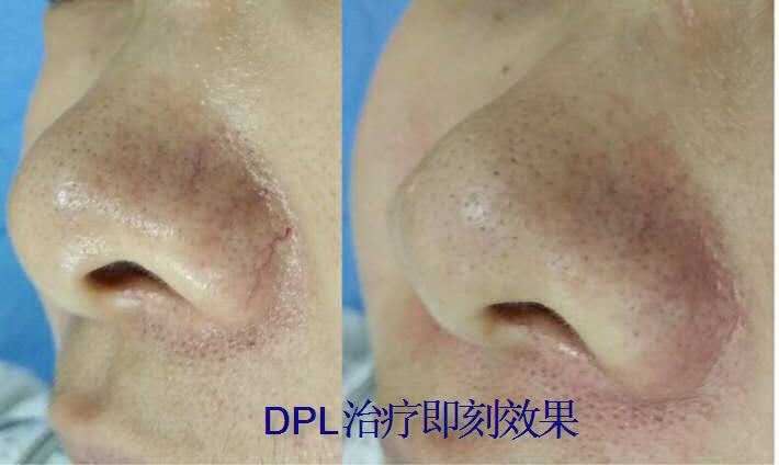 DPL���ƺ�Ѫ˿